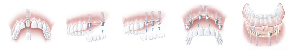 Implanty zębowe i uzupełnienia protetyczne