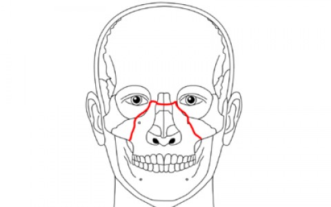Leczenie operacyjne złamań kości twarzy